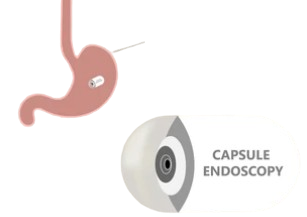 Capsule Endoscopy  