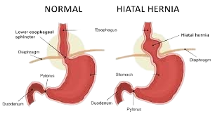 Top Gastroenterologist Mumbai for Difficulty in Swallowing
